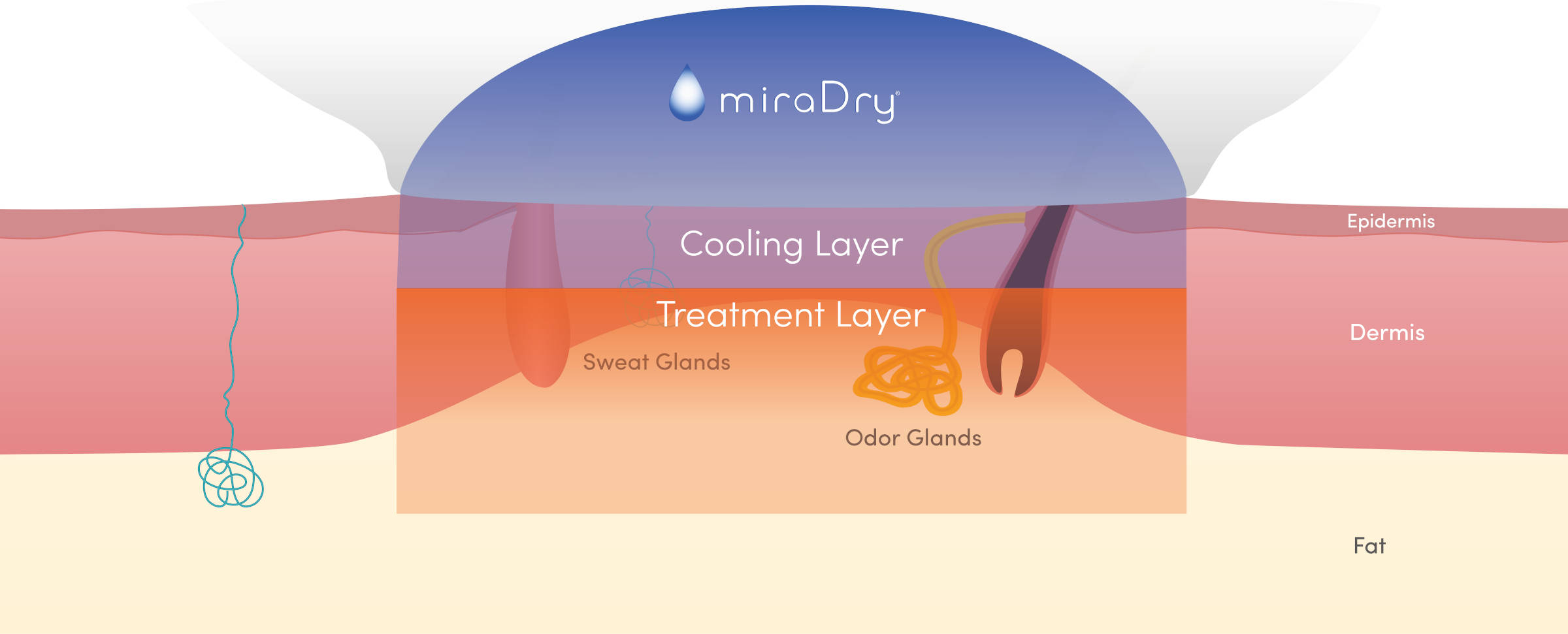 During treatment with miraDry